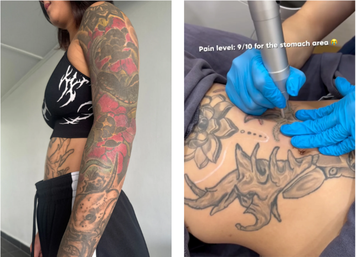 フーさんは左腕を覆うタトゥーすべてを除去したい考えだ。右の写真は本人のインスタグラムから。フーさんは毎回の治療の様子を記録している
